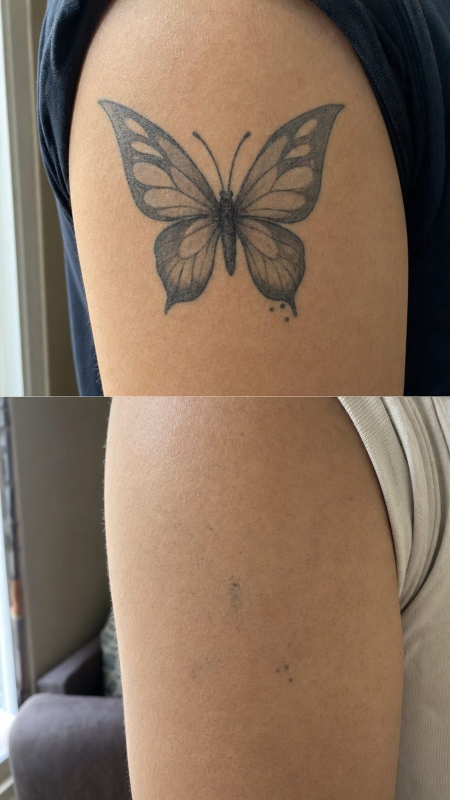 上臂蝴蝶纹身:治疗前与三次治疗后,吉隆坡 Removal-KL 洗纹身真实案例
