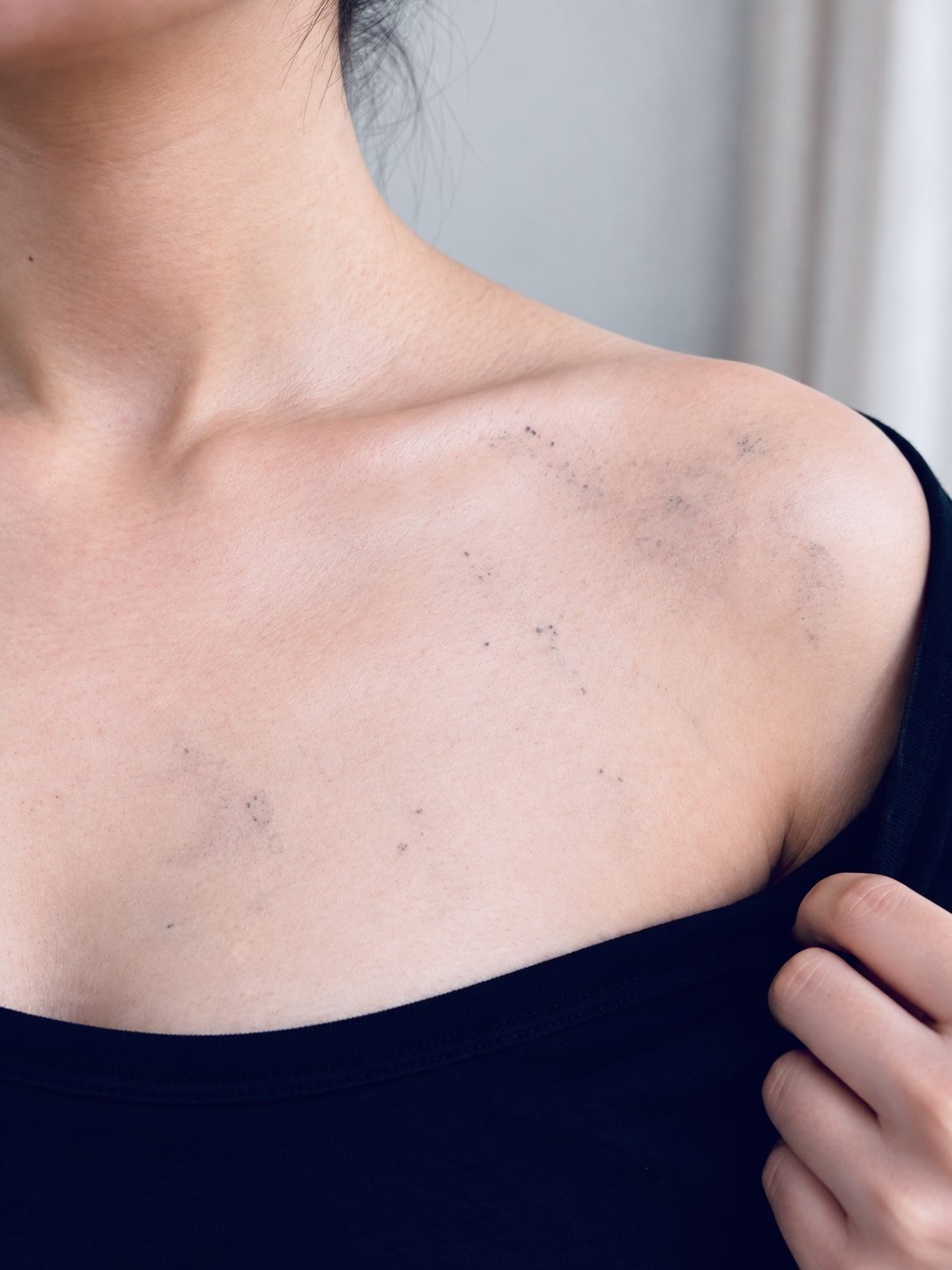 四次以上治疗后明显淡化,吉隆坡 Removal-KL 洗纹身真实案例